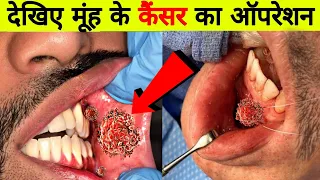 देखिए मूंह के कैंसर का ऑपरेशन कैसे करते हैं डॉक्टर || Mouth Cancer Symptoms and Treatment in hindi