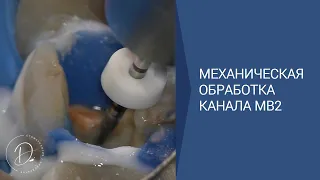 Механическая обработка облитерированного канала МВ2