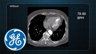 The challenge of coronary motion and patient heart rate in Cardiac CT | GE Healthcare