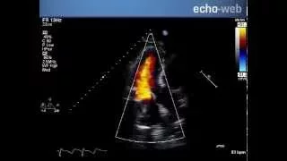 TheEchoWeb - Mitral Valve Replacement