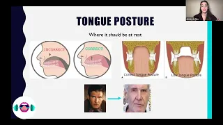Correct Tongue Posture: Why correct tongue posture affects your whole face (including your teeth!)