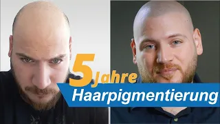 Haarpigmentierung Erfahrungen: 5 Jahre nach der Pigmentierung | Dr. Pigment