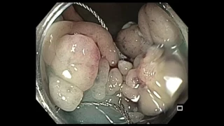 Colonoscopy: Transverse Colon - LST - Mixed - EMR