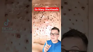 😲Most Blackheads I Have Ever Seen - BLACKHEAD REMOVAL #shorts