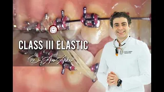 Orthodontic class III elastic step by step by Dr. Amr Asker #rubber_bands