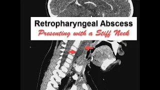 Neck Stiffness with Retropharyngeal Abscess