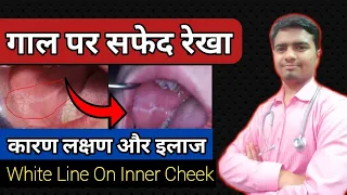 मुंह के अंदर गाल पर सफेद रेखा लाईन कारण लक्षण और इलाज. White line in mouth. Linea alba mouth.