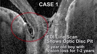 Inner Retinal Fenestration for Optic Nerve Pit Maculopathy