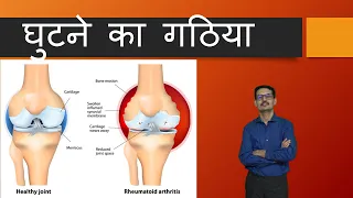 Knee Swelling due to Rheumatoid Arthritis.घुटने का गठिया