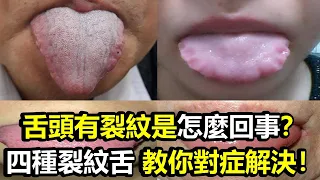 舌頭有裂紋是怎麼回事？四種裂紋舌，教你對症解決！