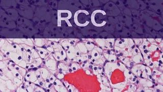 Renal Cell Carcinoma - Pathology mini tutorial