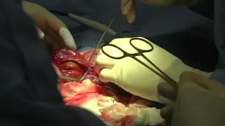 Hepatic lobe clamping with atraumatic vascular clamps in a dog