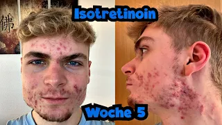 Noch mehr Pickel und keine Besserung!? || Isotretinoin Tagebuch Woche 5