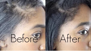 How to: Conceal Thin Edges, Traction Alopecia, & Bald Spots in Seconds!