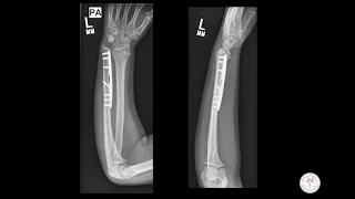 orthoPAc images: What is causing this young athlete's wrist pain?