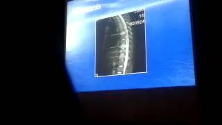 Spinal Neoplasms I Dr. Salwa