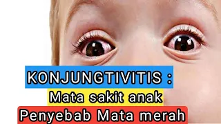 Konjungtivitis: Penyebab Mata Merah dan Sakit pada Anak | Tips Merawat Mata Anak