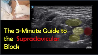 Supraclavicular Brachial Plexus Block - a 3-Minute How-to Guide