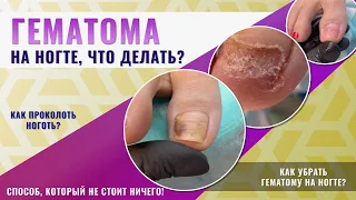 Гематома на ногте, что делать? Как убрать гематому на ногте? Как проколоть ноготь?