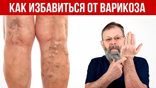 Варикоз. Как справиться? Причины. Как избежать?