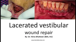 Suturing of Lower Vestibular Laceration by Dr. Niroz Bhattarai