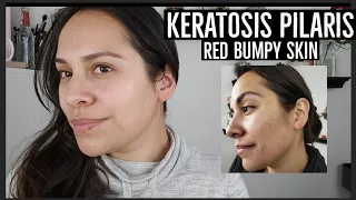 KERATOSIS PILARIS ON FACE - RED BUMPS/CHICKEN SKIN - HOW I MANAGE KERATOSIS PILARIS