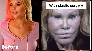 15 Worse Celebrity Plastic Surgery Disasters