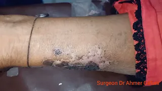 Dry Gangrene Hand Converted to Wet ...It's Due To Arterial Ischemia...We Will do amputation