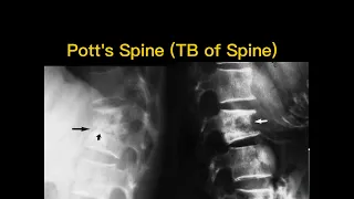 Pott's spine and TB of hip