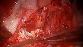 PICA( posterior inferior cerebellar artery) Aneurysm - clipping microsurgery