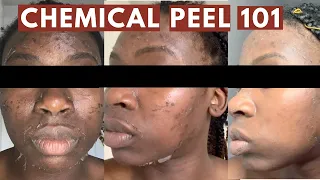 I TRIED A CHEMICAL PEEL!! | DO'S & DON'TS