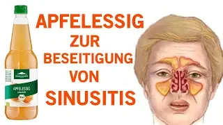 Wie du eine Sinusitis innerhalb von Minuten mit Apfelessig los wirst!