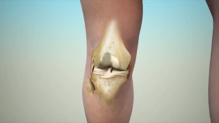 Stages of Knee Osteoarthritis