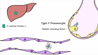 Bacterial Pneumonia - Pathogenesis