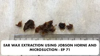 EAR WAX EXTRACTION USING JOBSON HORNE AND MICROSUCTION - EP 71