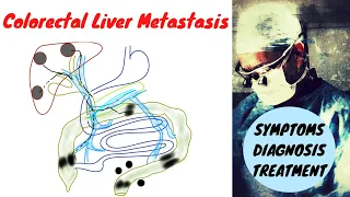 Stage 4 Colon Cancer (Liver Metastasis); Symptoms Diagnosis Treatment
