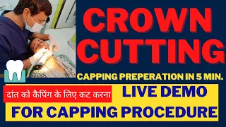 दांत को कैपिंग के लिए कट करना -LIVE DEMO FOR CROWN PREPERATION FOR CAPPING/BRIDGE-DR.PRAVEEN BHATIA