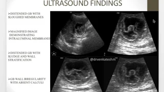 Gangrenous cholecystitis - A rare Entity