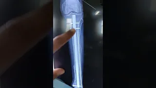 United Fracture Tibia with IMIL Nail in  situ..For Implant Removal ..Dr Sai Chandra MBBS DNB Ortho