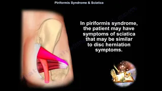 Piriformis Syndrome & Sciatica - Everything You Need To Know - Dr. Nabil Ebraheim