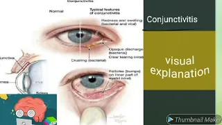 Conjunctivitis, classification,clinical features