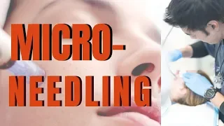 MICRO NEEDLING: What you need to know, from dermatologist | Dr Davin Lim