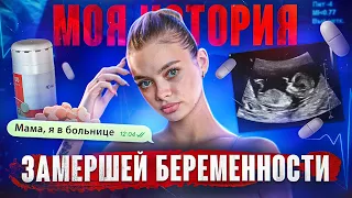 МОЯ ИСТОРИЯ ЗАМЕРШЕЙ БЕРЕМЕННОСТИ. Аня Ищук