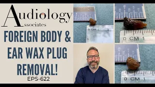 FOREIGN BODY & EAR WAX PLUG REMOVAL! - EP622