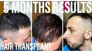 5 МЕСЯЦЕВ ПОСЛЕ ПЕРЕСАДКИ ВОЛОС В ТУРЦИИ / TRANSPLANT HAIR / Пересадка волос  FUE. Первые результаты