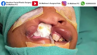 Rare case of Treacher Collins syndrome cleft lip closure done by Dr Mathew; kerala- south india