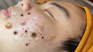 Relax Skincare Everyday with Acne Blackheads Treatment Spa #98059