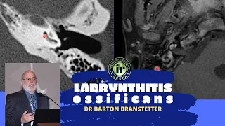 TMT: Labrynthitis Ossificans by Dr Barton Branstetter