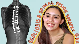 *very late* Spinal Fusion Surgery as A Dancer with Scoliosis Q&A