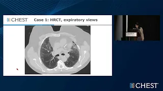 Mock Multidisciplinary Discussion in Interstitial Lung Diseases - To Biopsy or Not